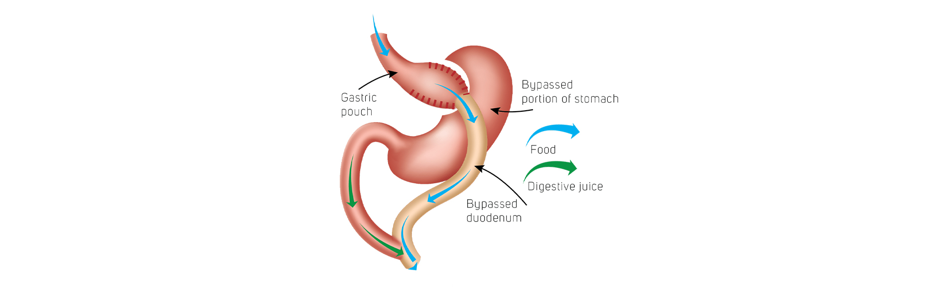 Duodenal Switch